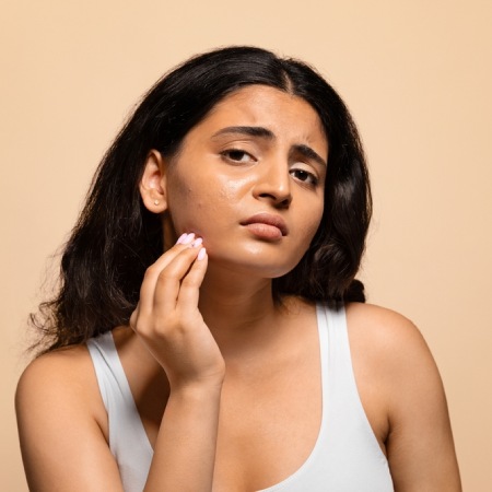 ACNE Scar